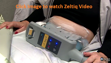 Zeltiq Video from Good Morning America